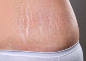 Unsightly stretch marks? Deal with them!