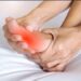 Natural Remedies for Gout Attacks